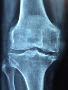 Knee X-ray