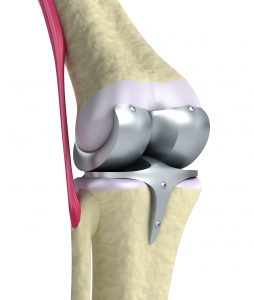 Attune Artificial Knee Replacement