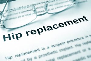 Artificial hip replacement and hip resurfacing