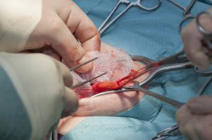 The surgeon is placing a hernia mesh to strengthen the inguinal region during open inguinal hernia repair.