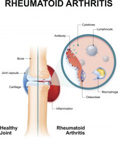 Rheumatoid Arthritis and Actemra