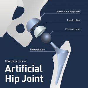 Artificial Hip Joint Showing femoral head and femoral neck and stem