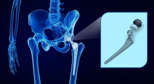 Exactech plastic liner in artificial hip system